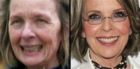 Diane Keaton Nose Job Skin Plastic Surgery Before And After Photos