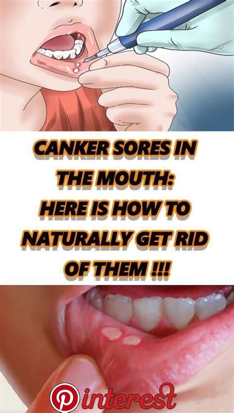 home remedies for canker sore on tongue beautypro clubf tongue sores gum health mouth