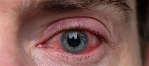Tell Tale Signs Of An Eye Infection
