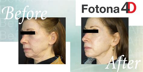 Fotona 4d Facial Aesthetics By Eileen