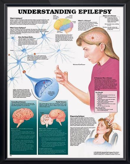 Understanding Epilepsy Chart X Epilepsy Medical Posters Medical Technology