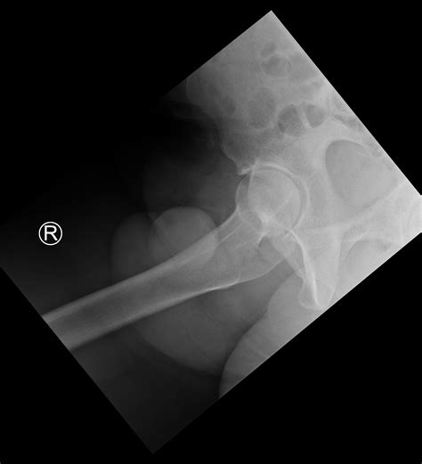 Femoroacetabular Impingement Fai Image Radiopaedia Or