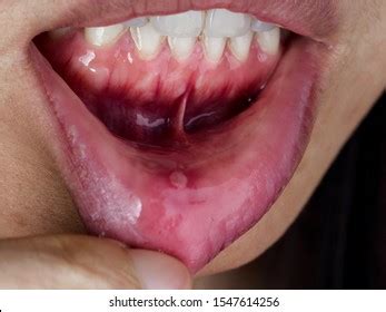 Larynx Throat Glands Tongue Viral Lingitis Stock Photo 1446528683