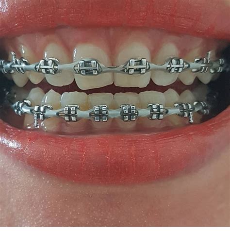 √ Light Blue Braces Color