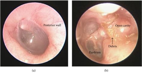 Otomycosis (fungal ear infection of the outer ear canal). (a) Normal contour of the external ear canal in the lef ...