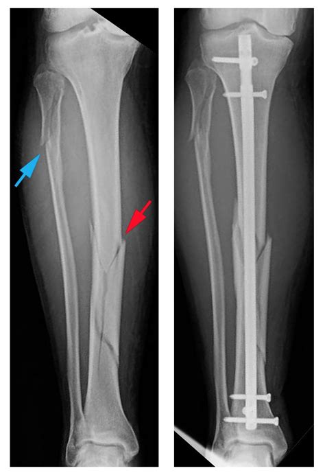 Tibia And Fibula Fractures