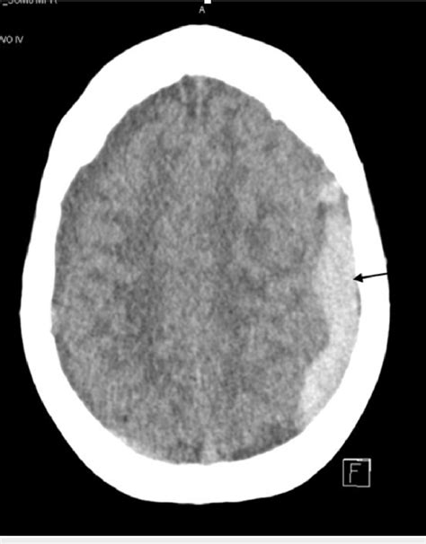 Brain Computed Tomography Longitudinal Section Left Subdural Hematoma