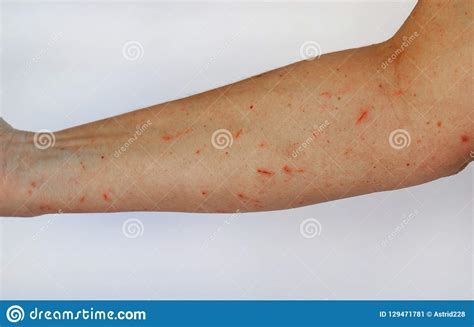 A Woman Has Injuries And Cuts On Her Arm Stock Image Image Of Claw