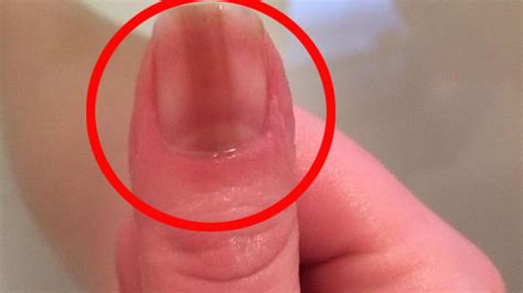 Mark On Womans Fingernail Was Melanoma Cancer Herald Sun