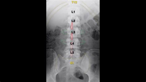 Lumbar X Ray Interpretation Osce Guide Radiology Geeky Medics