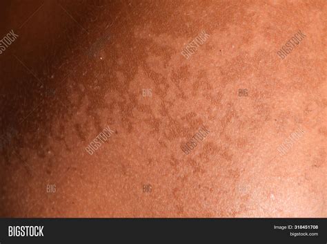 Sunburn On Skin Image And Photo Free Trial Bigstock