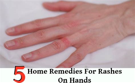 5 Home Remedies For Rashes On Hands Diy Home Remedies Kitchen
