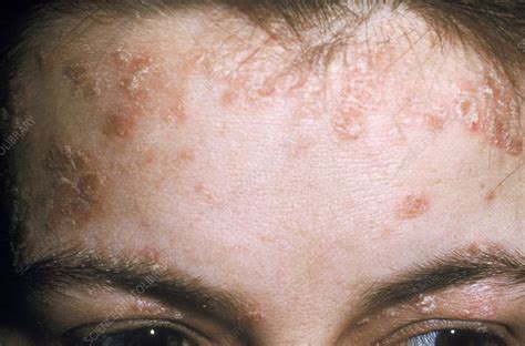 Seborrhoeic Dermatitis Stock Image C0177147 Science Photo Library