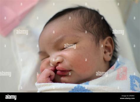 Newborn Baby With Cleft Lip And Palate Sleeping Stock Photo 60934329