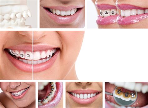 Orthodontics Types Of Braces