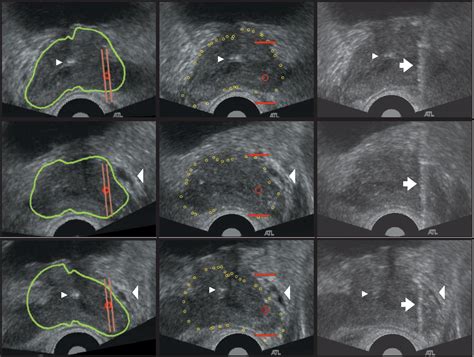 Figure 5 From Mechanically Assisted 3d Ultrasound Guided Prostate