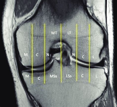A Coronal Proton Density Mr Image With Distinct Femoral And Tibial