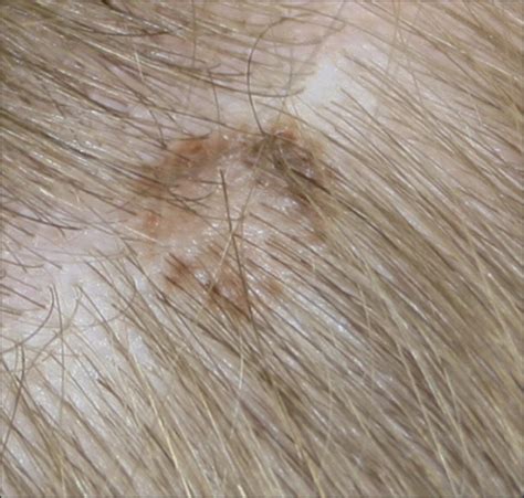 No Biopsy Needed For Eclipse And Cockade Nevi Found On The Scalps Of