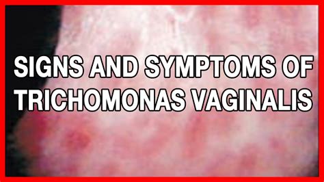 Signs And Symptoms Of Trichomonas Vaginalis Or Trich In Men And Women YouTube