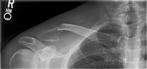 Management Of Distal Clavicle Fractures Post Orthobullets