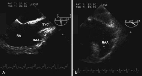 The Role Of Echocardiography In Atrial Fibrillation And Flutter
