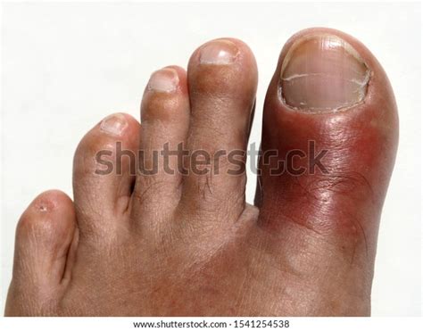 Big Toe Left Foot Red Swollen Stock Photo Edit Now