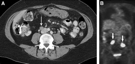 Current Concepts In Lymph Node Imaging