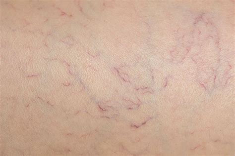 Spider Veins On Stomach Beauty And Health Facts Online Veins Cny