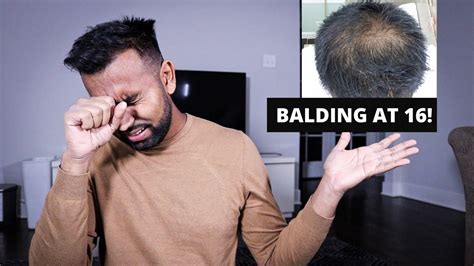 How To Deal With Balding As A Teen Mindsettreatmentsgrooming Youtube