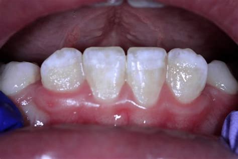 Icon Resin Infiltration Of White Spot Lesions Pediatric Dentist