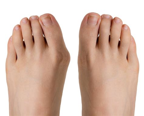 Premium Photo Hallux Valgus Before And After Surgery