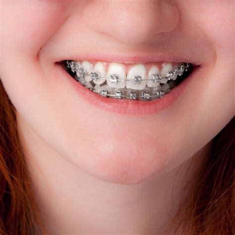 See more ideas about braces, brace yourself, orthodontics. Why Do-It-Yourself Braces Are A Bad Idea | I See A Happy Face