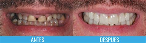 Rehabilitación Oral Clínica De Ortodoncia Medellín Cliorlaser