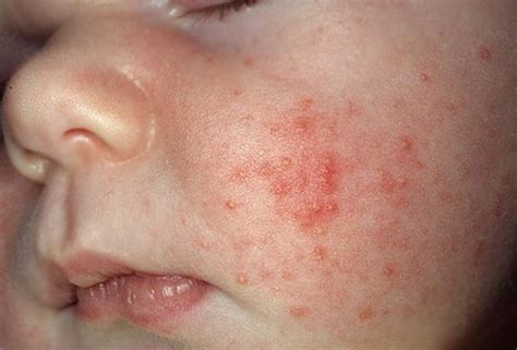 Baby Acne Causes Symptoms And Home Treatment Healthpulls