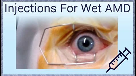 Injection Treatment For Wet Macular Degeneration Youtube