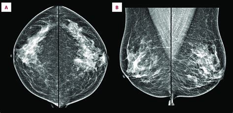 A Craniocaudal And B Mediolateral Mammograms Show A Focal Asymmetry