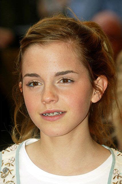 12 Famous Faces With Braces Celebrities With Braces Emma Watson Hair Emma Watson Beautiful