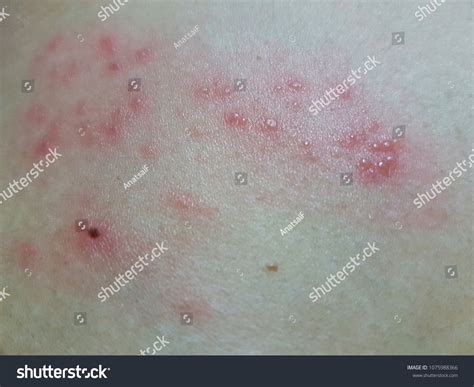 Herpes Zoster Shingles Skin Disease Caused Stock Photo Edit Now