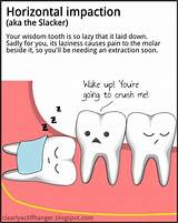 Emergency Dental Extraction Cost Images