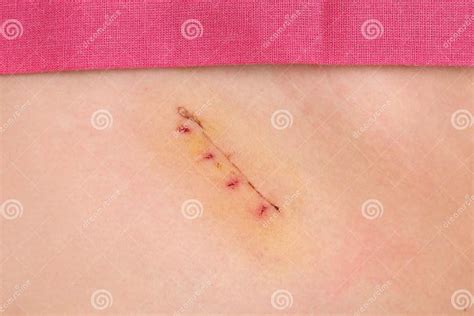 Medicine Appendectomy Surgery Scar Young Girl Stock Photo Image Of