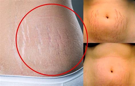 Before And After Pregnant Belly Stretch Marks Pregnantbelly