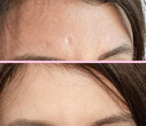 31 Microneedling For Acne Scars Before And After Pictures Images