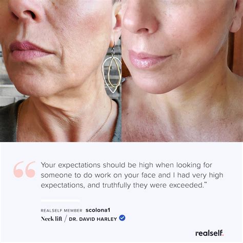 Neck Lift With Only Local Anesthesia In 2021 Neck Lift Face Lift