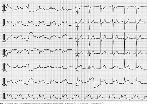 Figure 1 From Subarachnoid Hemorrhage Misdiagnosed As An Acute St