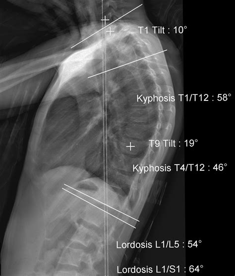 Hyper Kyphosis And Sheuermanns Disease Scoliosis Therapy Centre