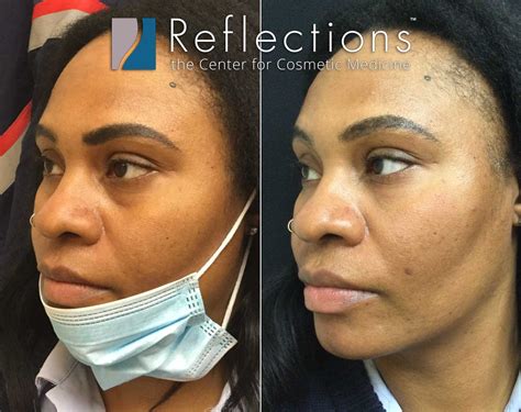Under Eye Filler with Cheek Support Pre-Treatment with Filler Before and After Photos New Jersey
