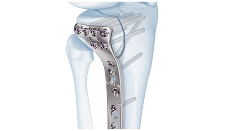 Knee Fracture Depuy Synthes