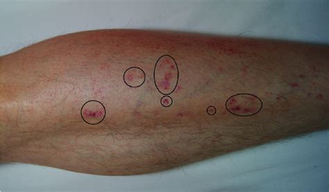 Petechiae On The Shin Of The Left Leg In Campaign 2 Hemorrhages Are