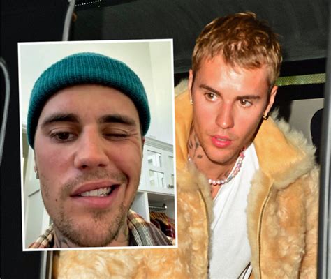 Justin Bieber Battling Serious Virus That Has PARALYZED Half His Face