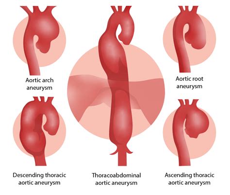 ascending thoracic aortic aneurysm
